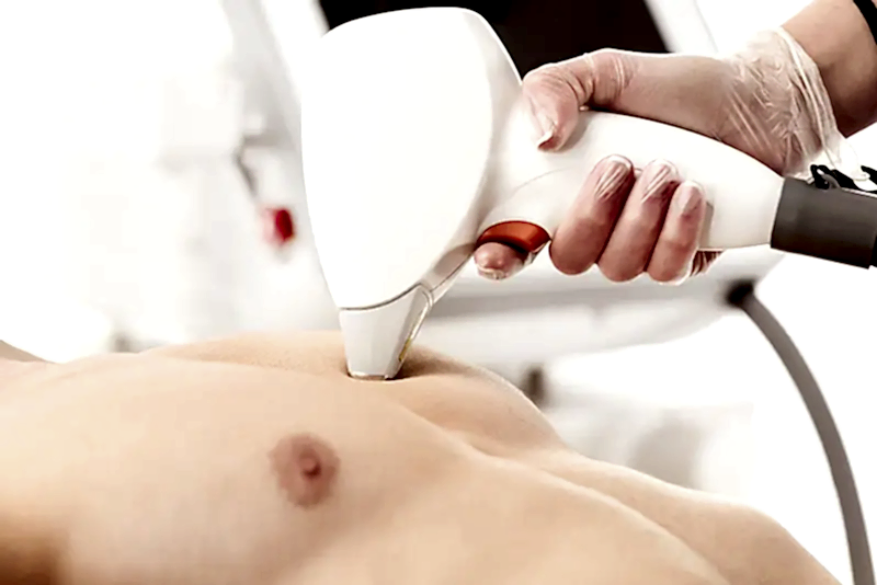 ankara lazer epilasyon fiyatı