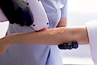 ankara lazer epilasyon fiyatları